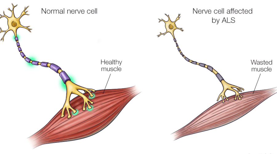 Νόσος κινητικού νευρώνα: Η εμφύτευση συσκευής στον εγκέφαλο επιτρέπει την επικοινωνία σε ασθενή