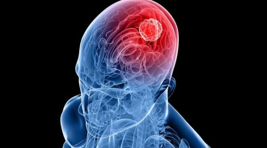 Προχωρά η μελέτη διάγνωσης εγκεφαλικών όγκων – Πώς θα γίνεται η εξέταση