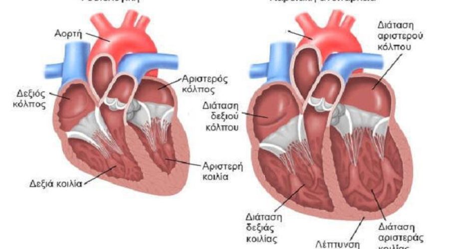 Καρδιακή ανεπάρκεια: Τα διαφορετικά συμπτώματα σε άνδρες και γυναίκες